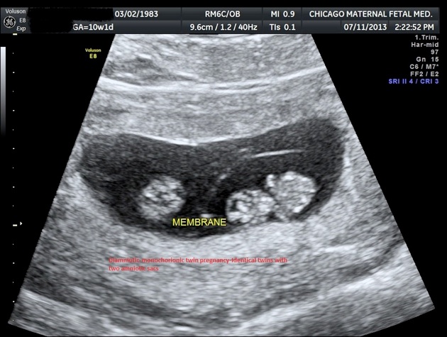Identical twin pregnancy